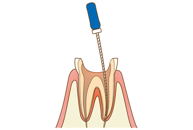 根管の感染物の除去