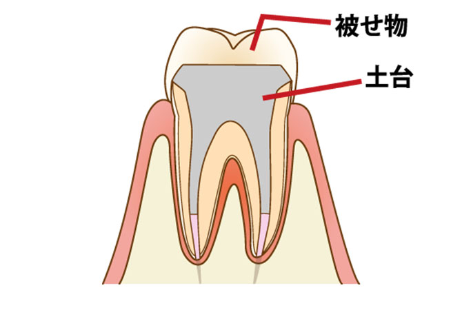 根管の充填